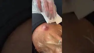 Шок. Огромный прыщ