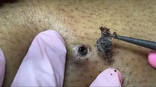 LEG EXTRACTION REMOVAL Ep.9  Ft MyMagicHealer