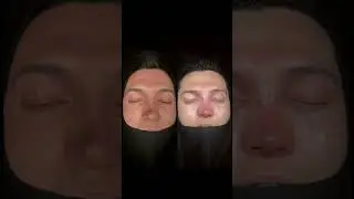 Revision Rhinoplasty Before After: Allogenic Rib Cartilage Used