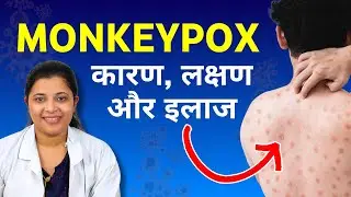 Monkeyppox Virus - Symptoms & Treatment - Monkeypox Kaise Failta Hai, Ilaj Kaise Kare?