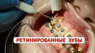 Ретинированные зубы – полный гайд по их выравниванию