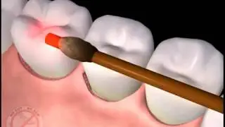 Periodontist in Ann Arbor, MI Shares LANAP Laser Periodontal Surgery for Gum Disease
