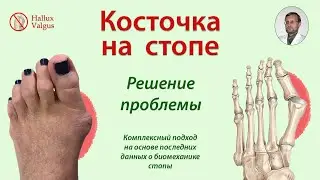 Косточка на стопе.  Решение проблемы.