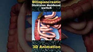 Understanding Biliopancreatic Diversion with Duodenal Switch Surgery: A Comprehensive Guide