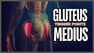 Understanding Gluteus Medius Trigger Points