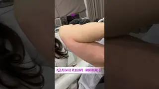 Если обвисла кожа после похудения - есть решение! RF-лифтинг Морфеус8. Подписывайтесь. Здесь💯польза