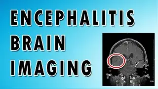 Medical Case 2: Encephalitis and Brain Infections