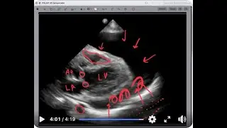 Cardiac US PSLX