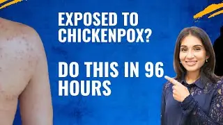 Chickenpox & Its Prevention #ChickenpoxAwareness #HealthForAll #preventioniskey #swastha