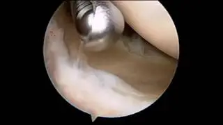 shoulder procedure