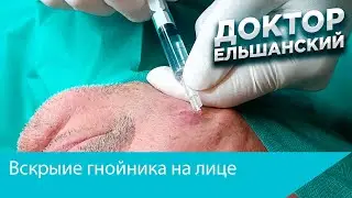 Вскрытие гнойника на лице