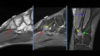 MRI Ankle Case 25