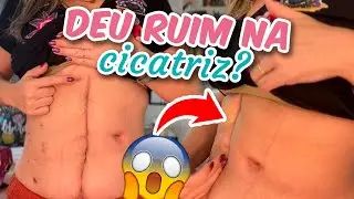 O que ACONTECEU com minha CICATRIZ