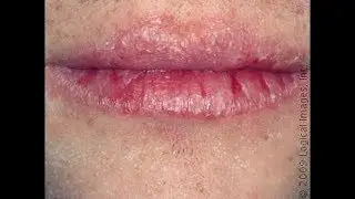 HUGE BUSTED LIP! | busted lip healing | How to Treat a cut lip