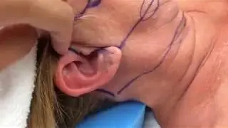3-D Facelift -  Inside and Outside the OR with Results -  Dr.  Anthony Youn