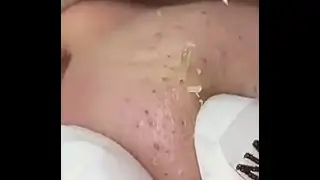 Removendo CRAVOS do NARIZ 👃🏼👃🏼 - Satisfatório
