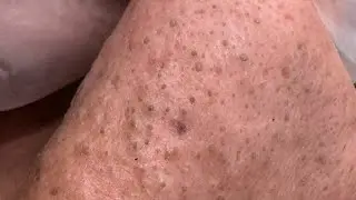 The best video to remove blackheads