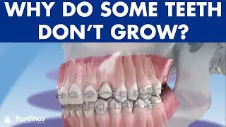 IMPACTED TOOTH - What to do when permanent teeth don't grow ©