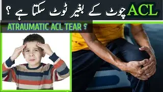 Non traumatic Acl tear | acl injury