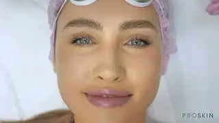 Фотоомоложение BBL в клинике