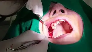 Закрытый синус-лифтинг с помощью денсификационных боров Haenaem