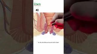 Piles Surgery I लेजर पाइल्स ऑपरेशन I Laser surgery for piles