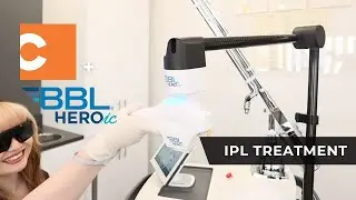 BBL® HEROic™️ IPL Treatment - Clearskin Institute of Laster Aesthetics