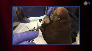 WCW: Removing Callus Formation from Toes