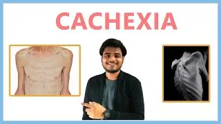 Cachexia (wasting syndrome)