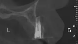 Critérios para a Remoção de Implantes
