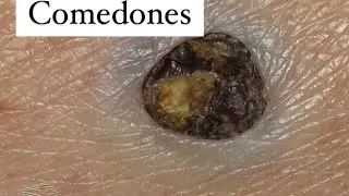 Solar & Senile Comedones! What are they?