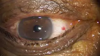 Ozurdex (Allergan) Intravitreal Implant | Retina Injection | Dr Madhusudan Davda