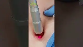 Laser Spider Vein Removal