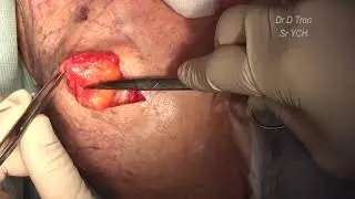 Lipoma excision from shoulder