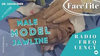 FaceTite: Journey To a Male Model Jawline