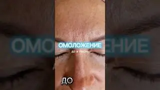 ОМОЛОЖЕНИЕ ЛБА ОТ АЛЛЫ ПУГАЧЕВОЙ #косметолог #петрпашков