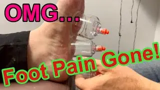 Amazing Treatment for Plantar Fasciitis!!