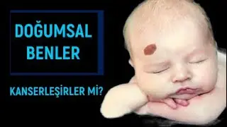 DOĞUMSAL BENLER NELERDİR BU BENLERİN CİLT KANSERİ RİSKİ VAR MIDIR?