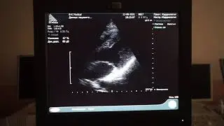 Фазированный датчик 2-4 МГц аппарата BK Medical 2202 ProFocus