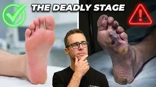 Can you die from peripheral neuropathy? [Early vs Late Symptoms]
