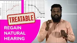 Sensorineural hearing loss treatment - TREATABLE