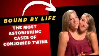 Bound by life. Conjoined twins