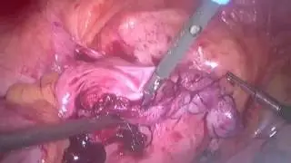 Laparoscopic Myomectomy for Large Fibroids