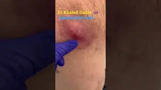 Massive cyst infection 