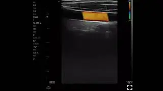 CONTEC color portable doppler CMS1600B clinical demonstration video