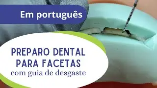 Preparo para faceta com guia de desgaste.