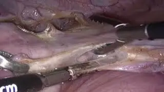 La Histerectomía Laparoscópica más limpia! -