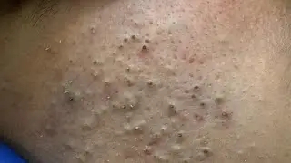 ASMR Deep Cleansing for Clear Skin - Blackhead & Pimple Removal Techniques
