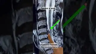 Neck Hernia. Tkachev Clinic.