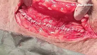 Small stich small bite SSSB tech of fascial closure